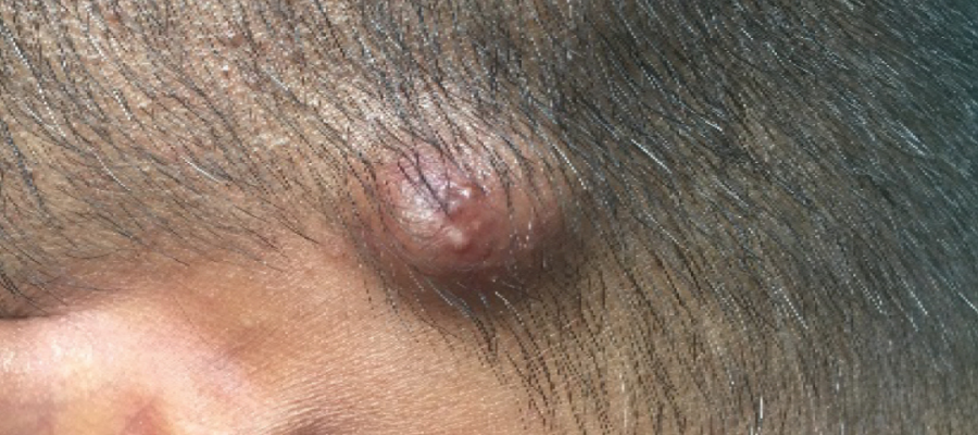 kafa derisi tümörü