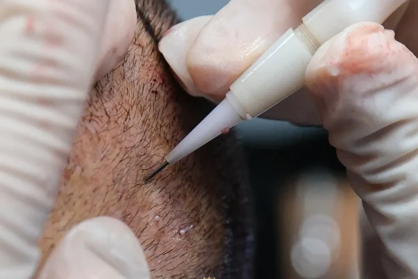 A ciência por trás do transplante capilar