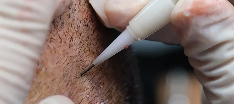 Saç ekiminin ardındaki bilim