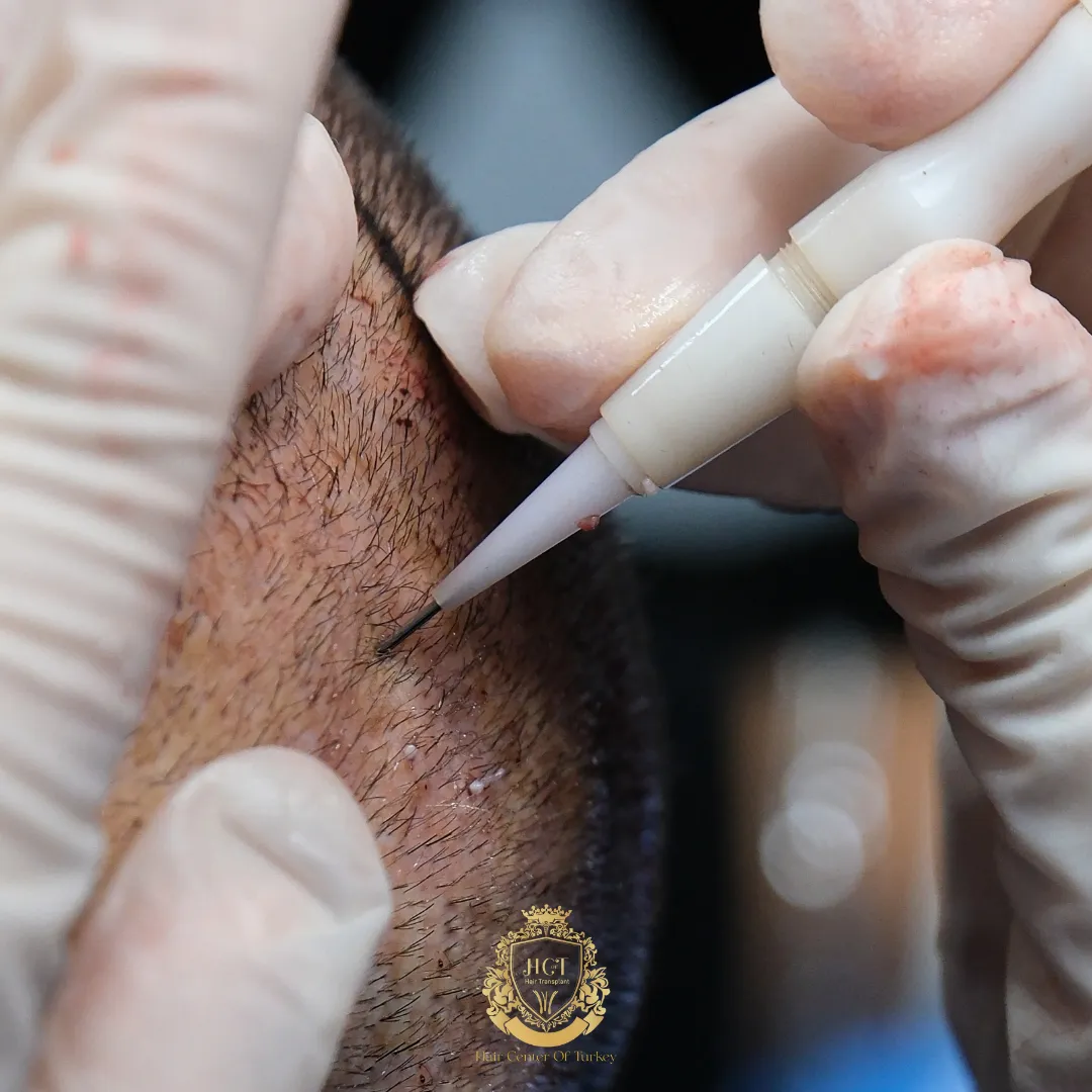 science behind hair  transplant