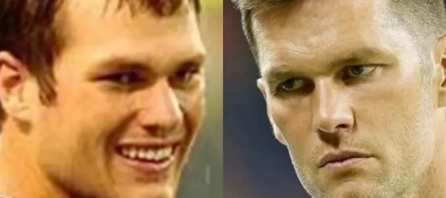 tom brady hair transplant