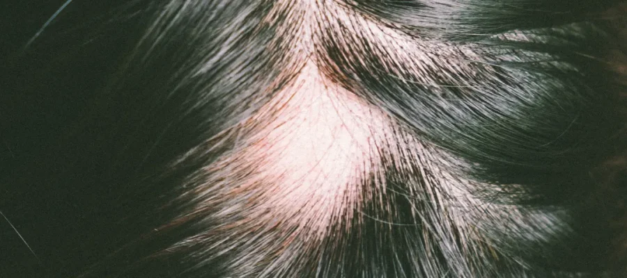 traction alopecia