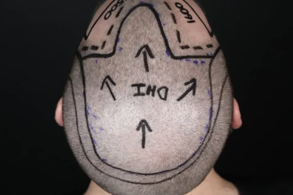 Transplante Capilar de Vértice (Area da Colina)