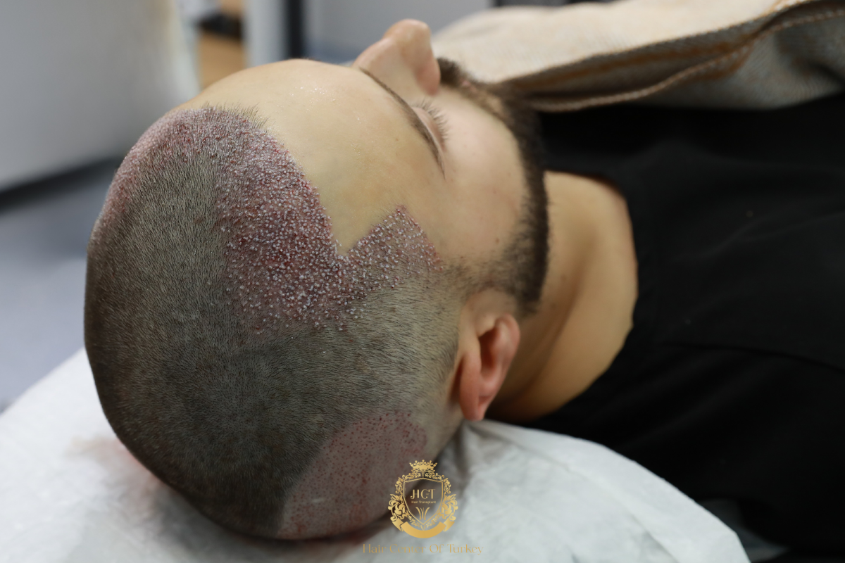 what is neo hair transplant receding hairline