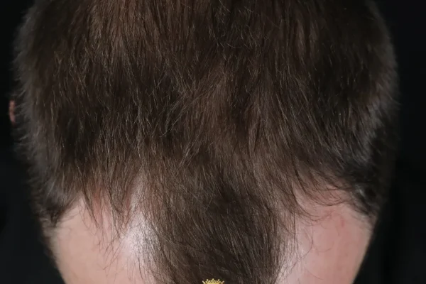 O que é uma linha capilar em forma de pico de viúva? Genética, prevalência e considerações estéticas.