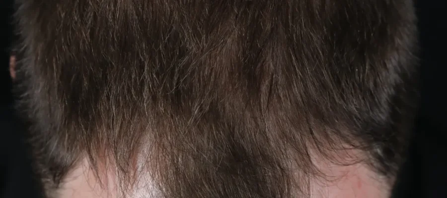 dul tepe saç çizgisi