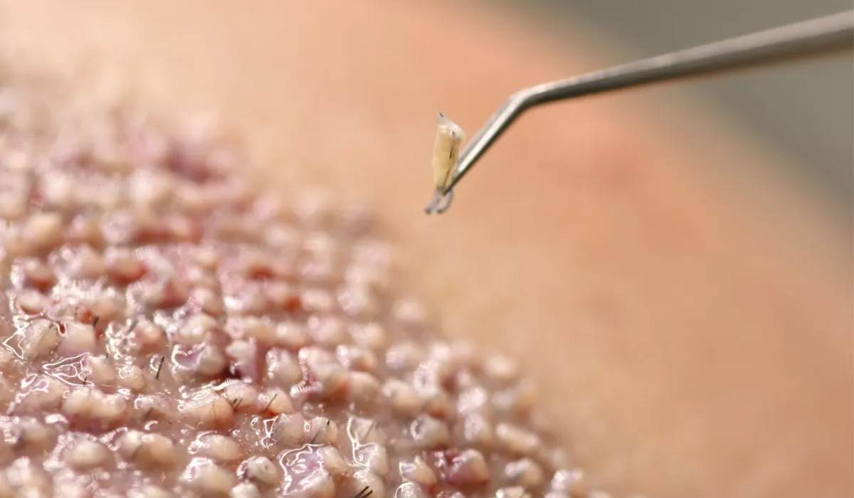 william-levy-Hair-Transplant-6 william-levy-Haartransplantatie-6