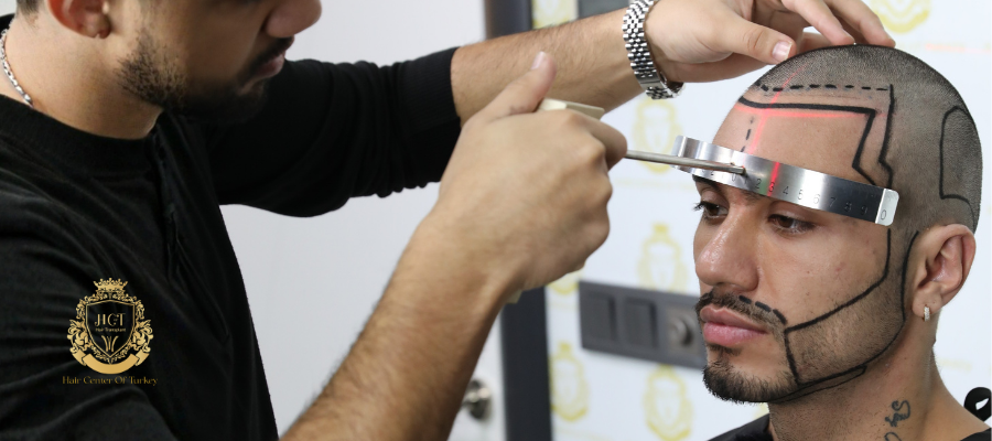 Transplante de barba