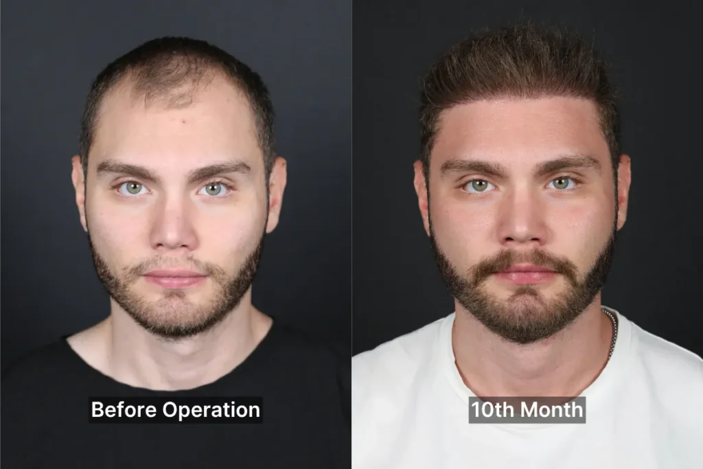 Après la Greffe de Cheveux