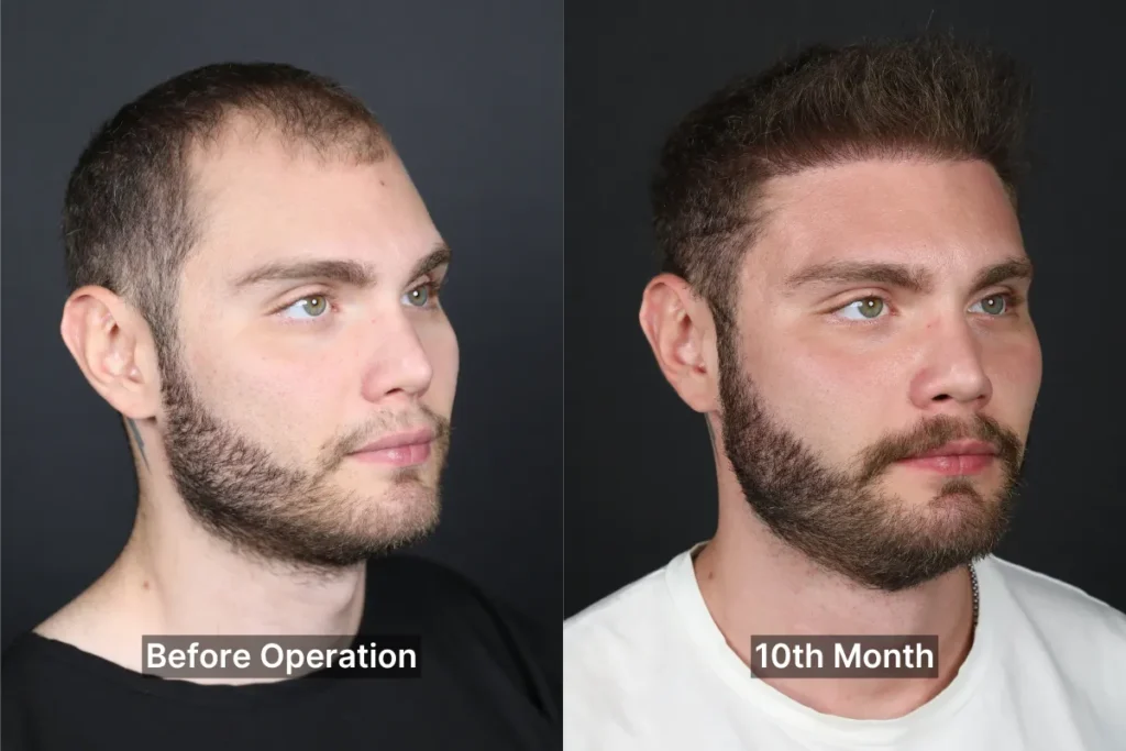 Après la Greffe de Cheveux