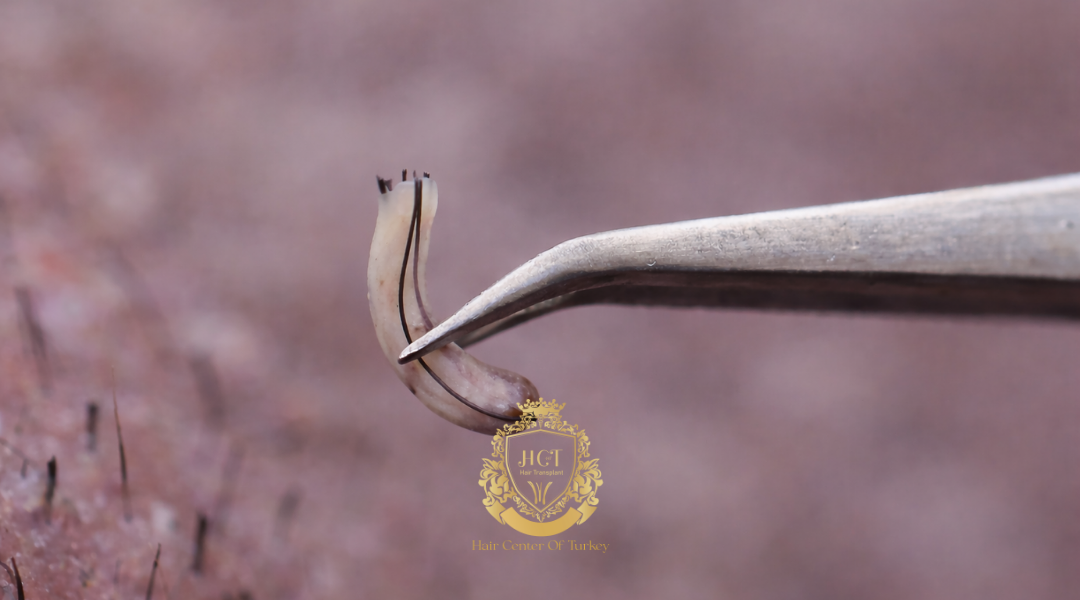 Afro Hair Transplant 3 Afro Hair Transplant