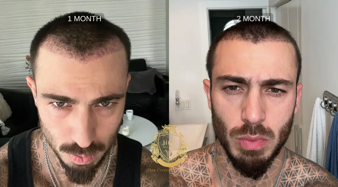 1er et 2e mois après greffe de cheveux