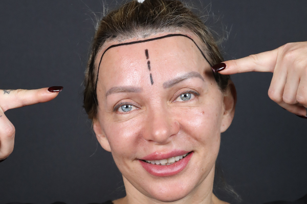 Haartransplantatie bij Vrouwen