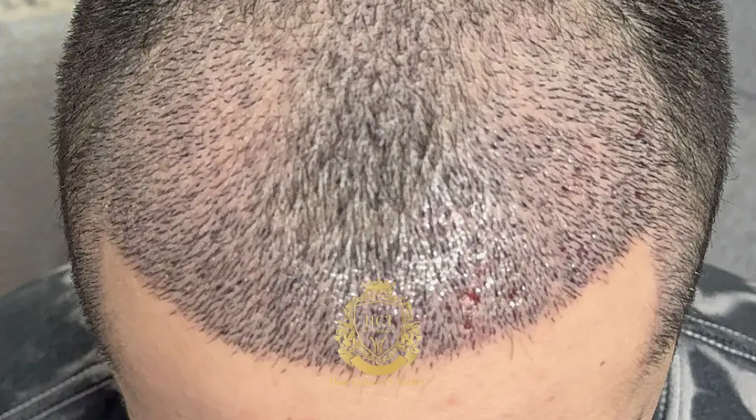 2 semaines après greffe de cheveux