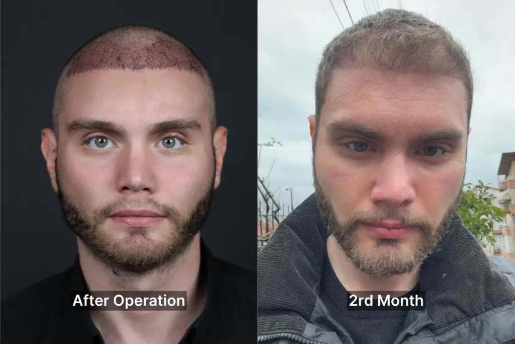 Après la Greffe de Cheveux