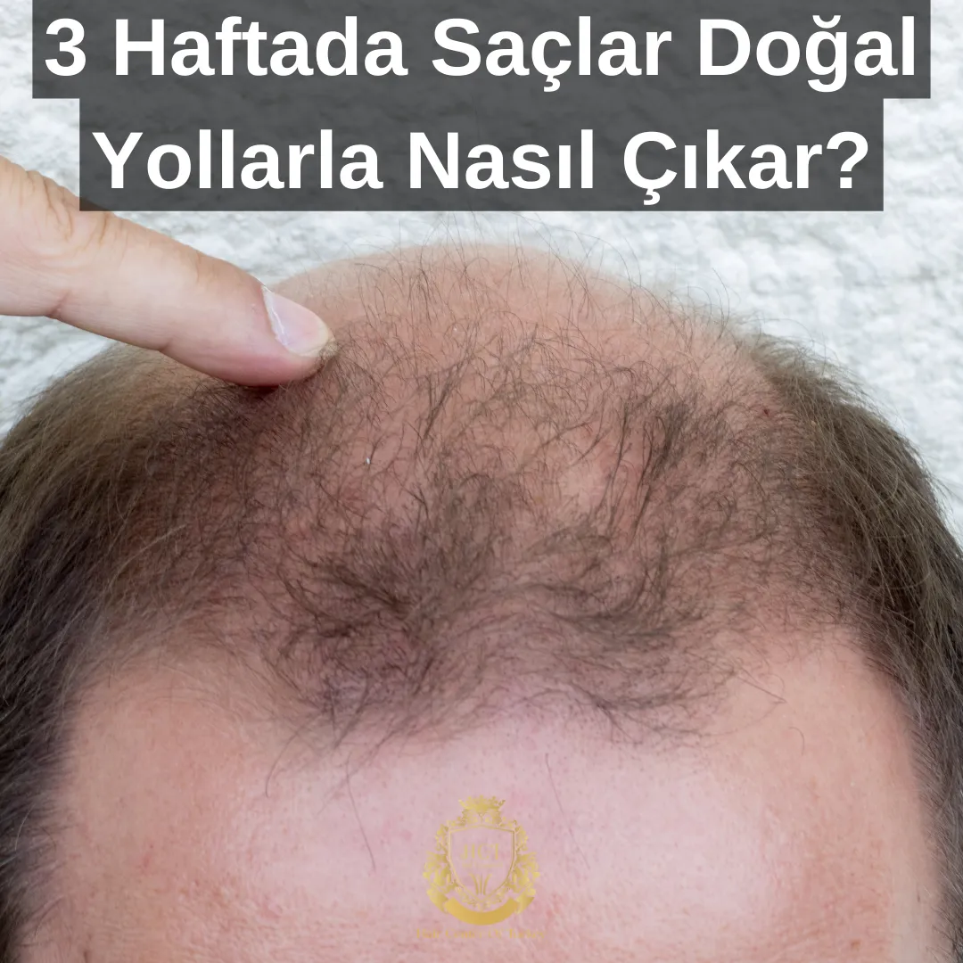 How To Regrow Hair Naturally in 3 Weeks|3 Haftada Saçlar Doğal Yollarla Nasıl Çıkar