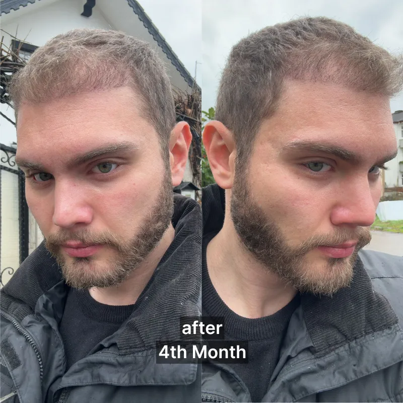 Après la Greffe de Cheveux