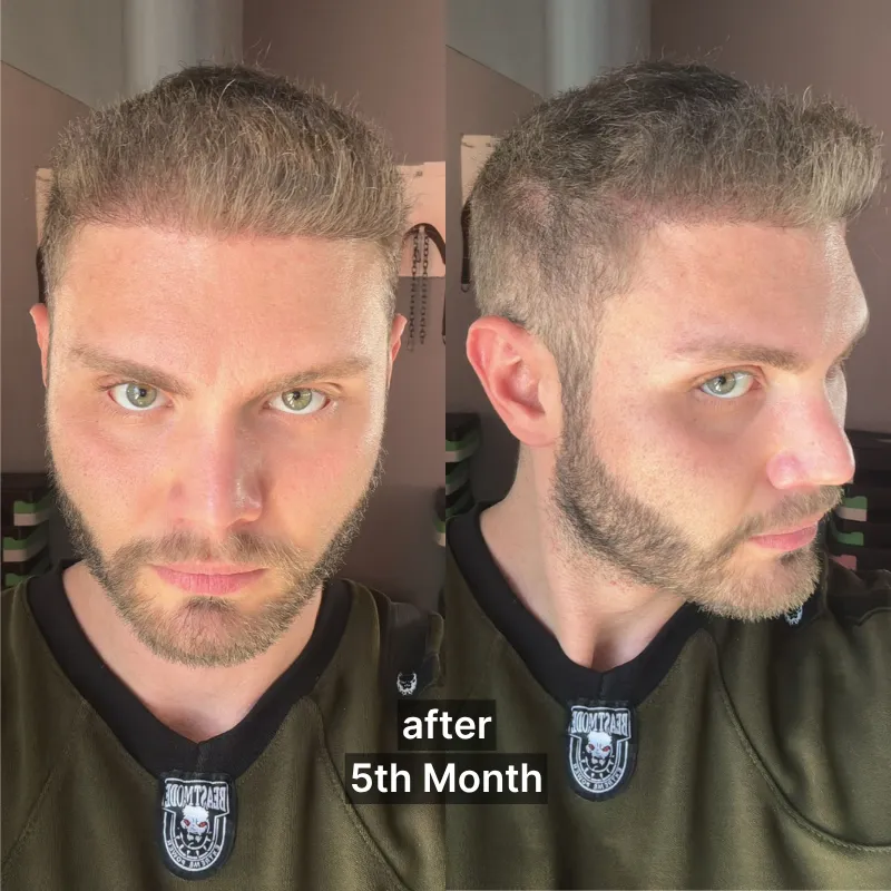 Après la Greffe de Cheveux