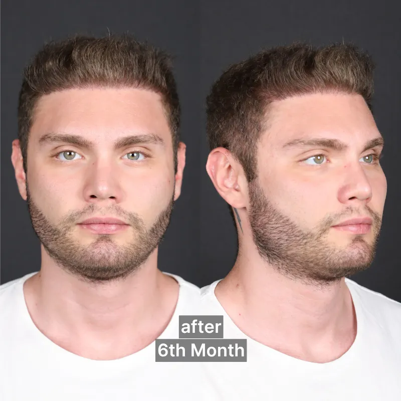 Après la Greffe de Cheveux