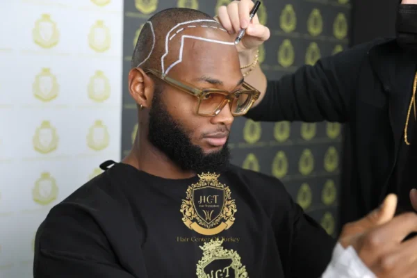 Greffe de Cheveux Afro en Turquie