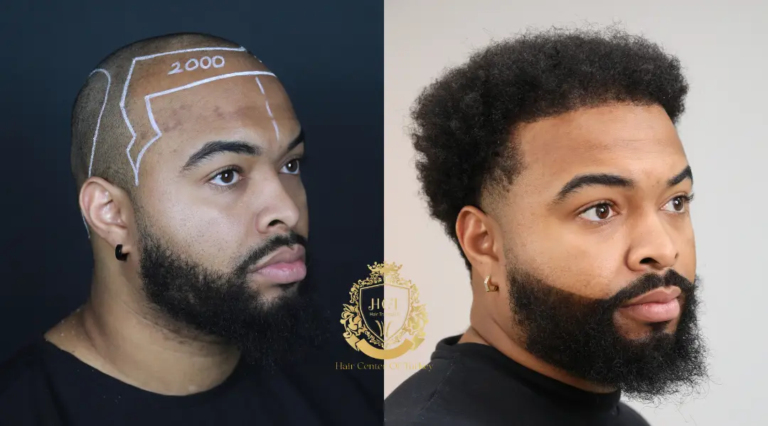 Afro Hair Transplant Before and After Results