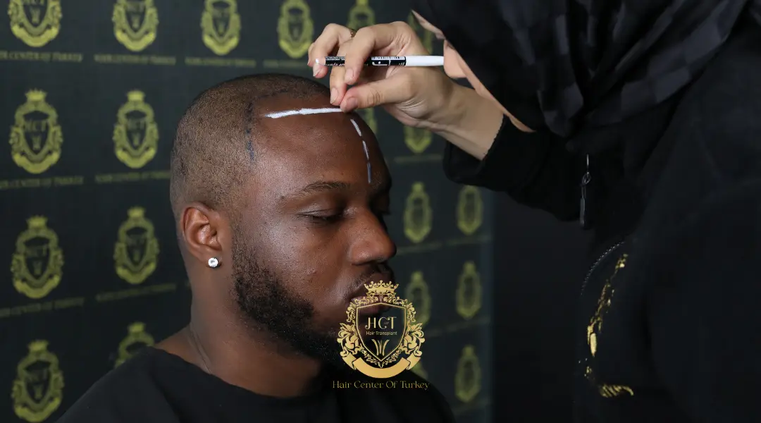 Afro Hair Transplant Turkey