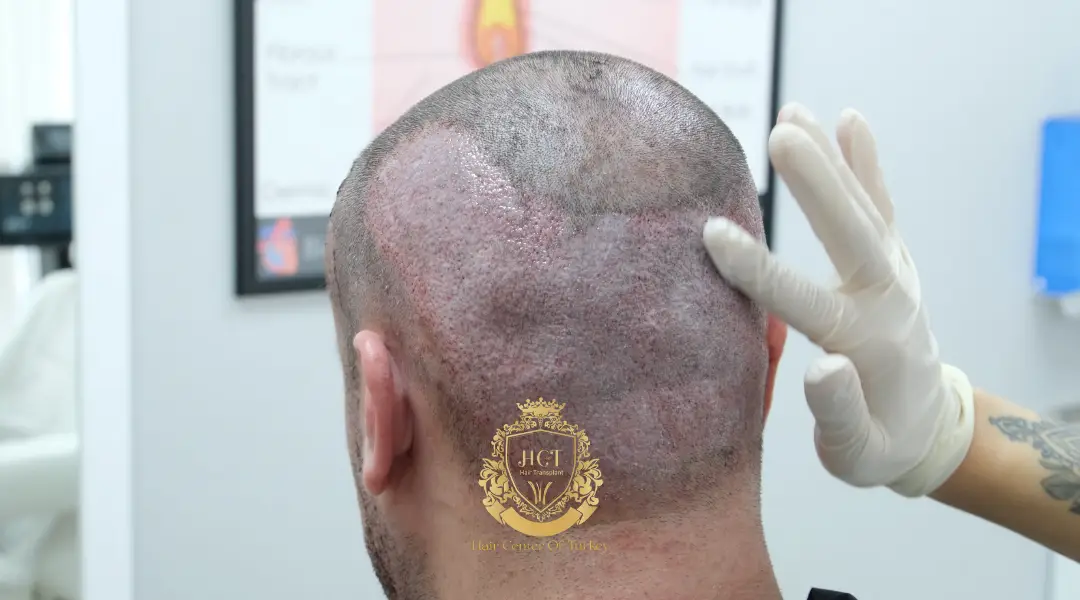 Après le nettoyage post-greffe de cheveux