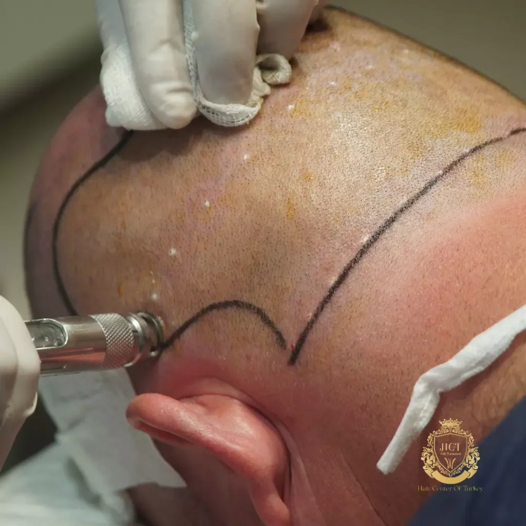 Pijnloze naaldloze haartransplantatie