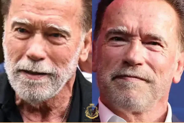 Arnold Schwarzenegger Haartransplantation