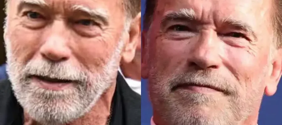 Arnold Schwarzenegger Haartransplantatie 1 Arnold Schwarzenegger Hair Transplant