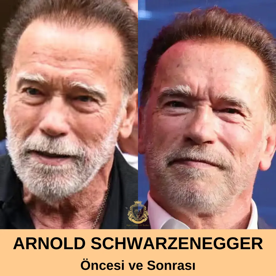 Arnold Schwarzenegger Saç Ekimi 1 Arnold Schwarzenegger Hair Transplant|Arnold Schwarzenegger Saç Ekimi