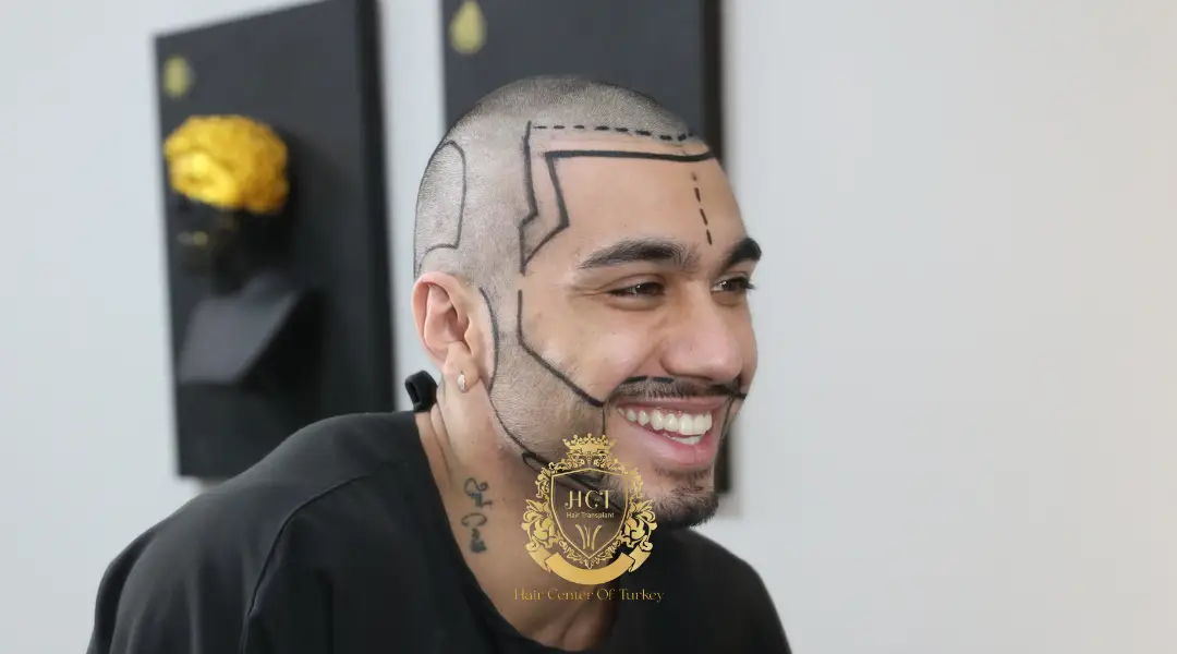 Trasplante de Barba 2 Beard and Mustache Transplant at Hair Center of Turkey