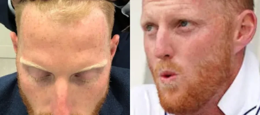 Ben Stokes Hair Transplant