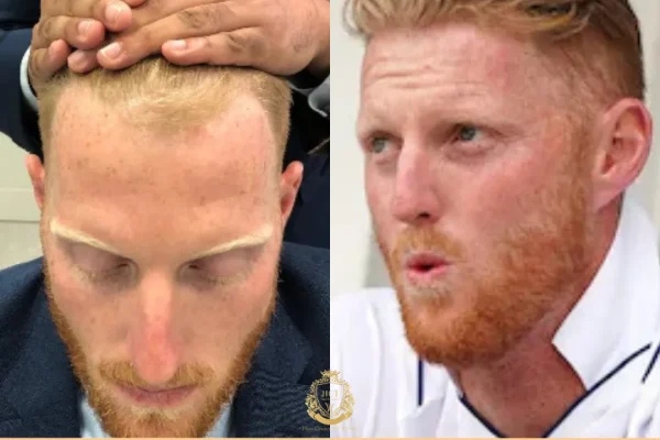 Ben Stokes Saç Ekimi