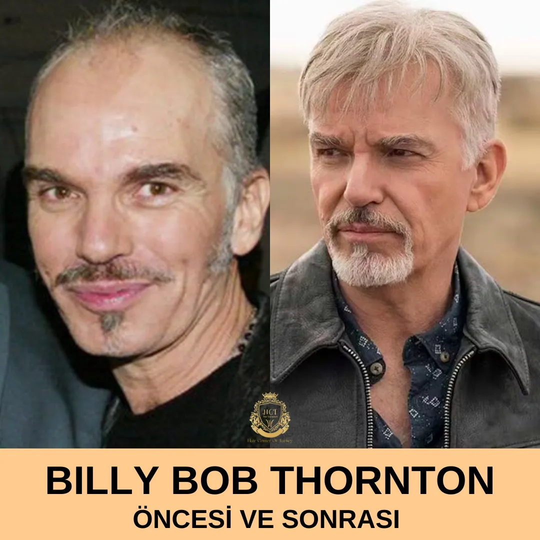 Billy Bob Thornton Hair Transplant |Billy Bob Thornton Saç Ekimi