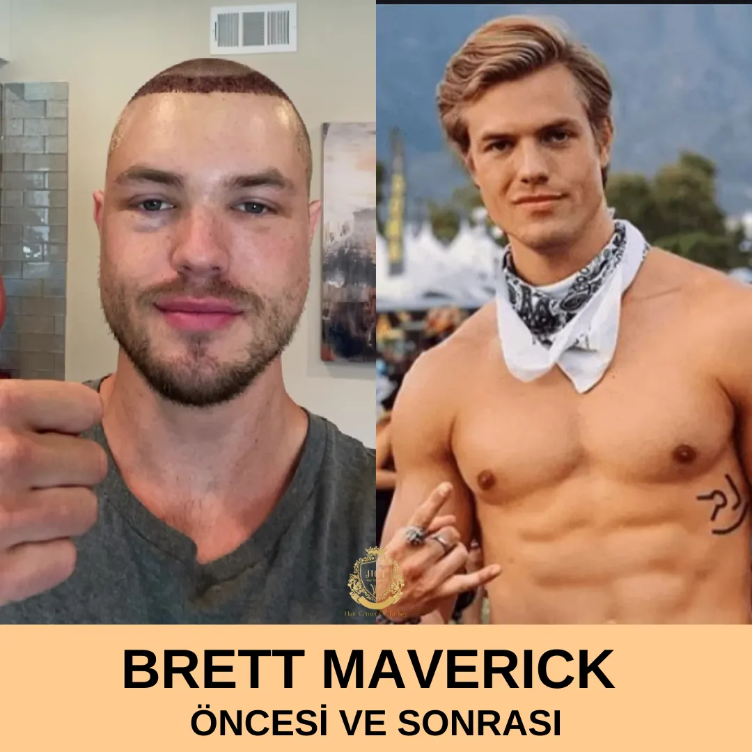 Brett Maverick Haartransplantatie 1 Brett Maverick Hair Transplant|Brett MaveriCK