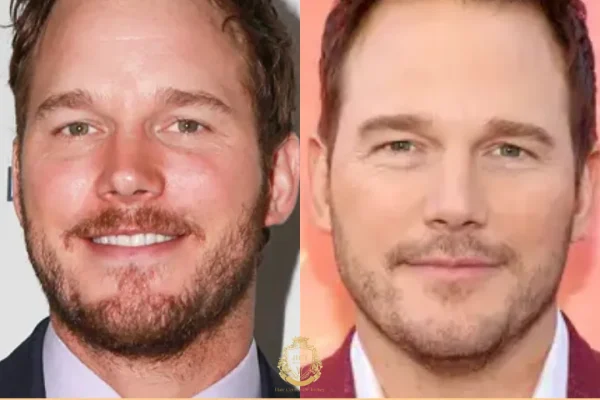 Chris Pratt Haartransplantation