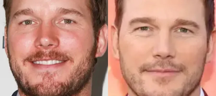 Chris Pratt Hair Transplant