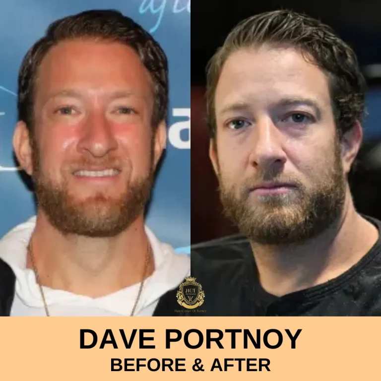 DAVE PORTNOY PRIMA E DOPO