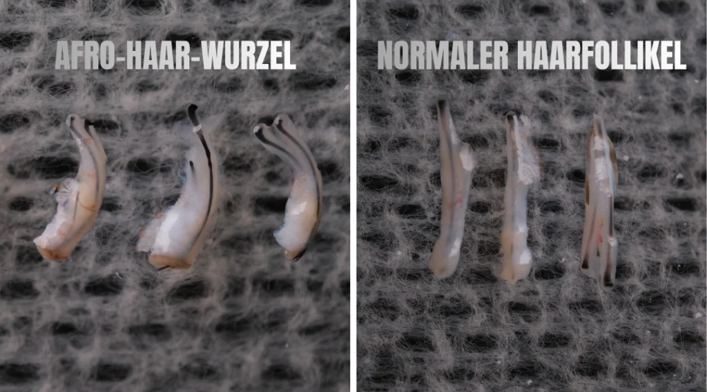 Afro-Haartransplantation in der Türkei 4 Afro-Haartransplantation in der Türkei