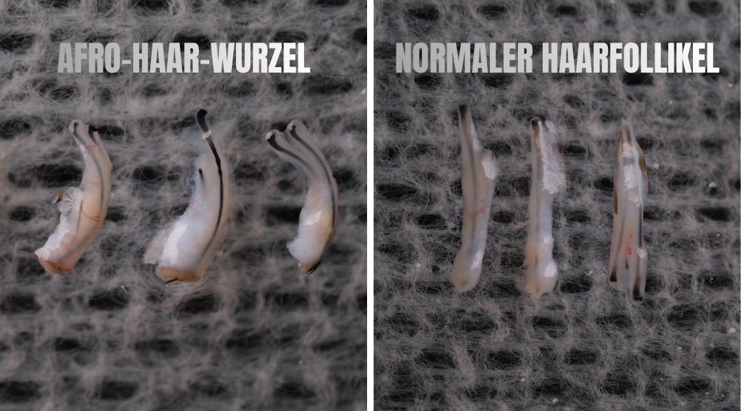 Afro-Haartransplantation in der Türkei