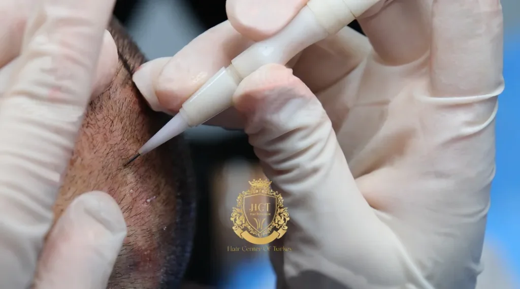 Transplante capilar DHI