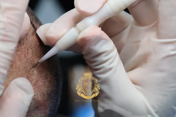 Transplante Capilar DHI