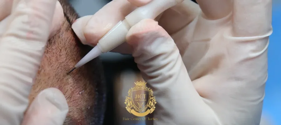 Transplante capilar DHI