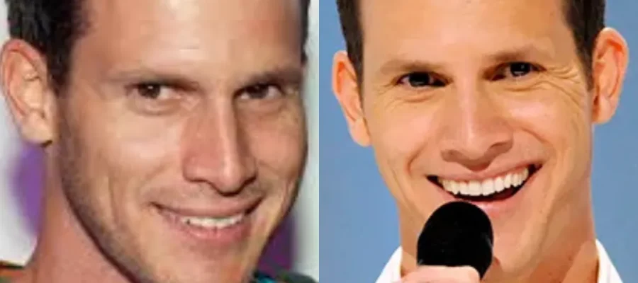 Daniel Tosh Hair Transplant Before and After