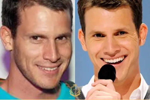 Daniel Tosh Haartransplantatie