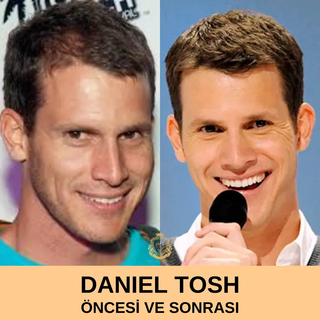 Daniel Tosh Trasplante de Pelo 1 Daniel Tosh Hair Transplant Before and After|Daniel Tosh Saç Ekimi Öncesi ve Sonrası