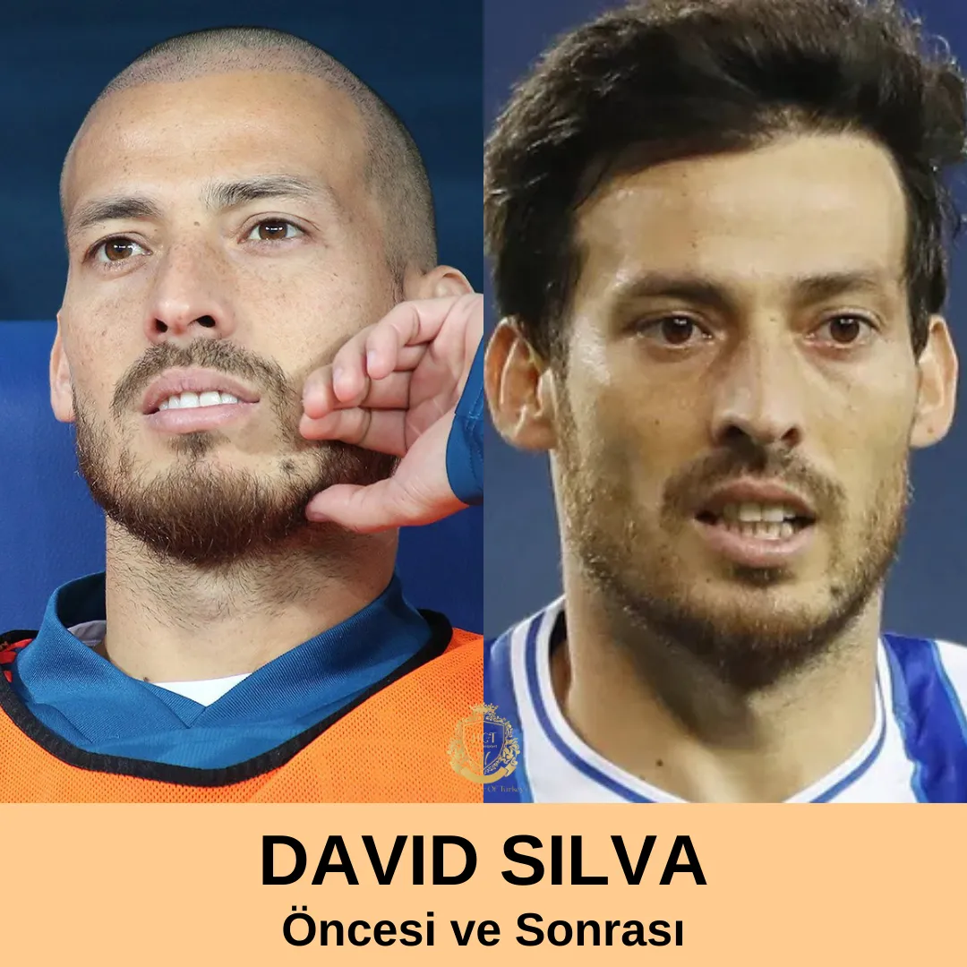 David Silva Saç ekimi 1 david silva Hair Transplant|David Silva Saç Ekimi