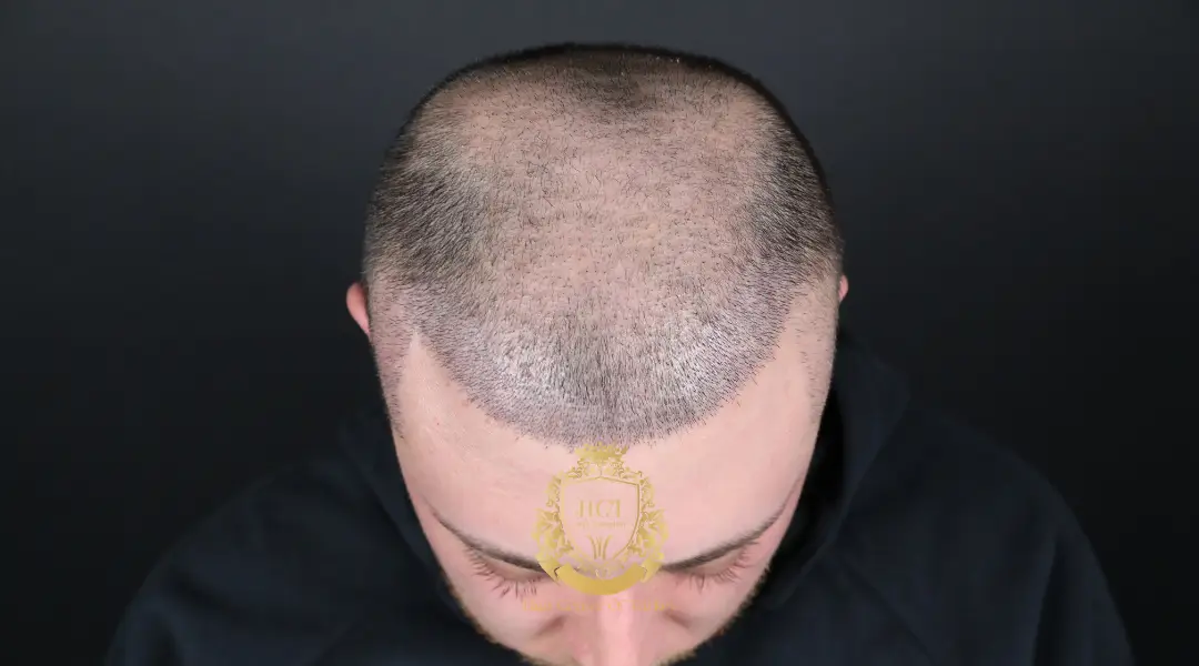 Jour 10 – Lavage final greffe de cheveux