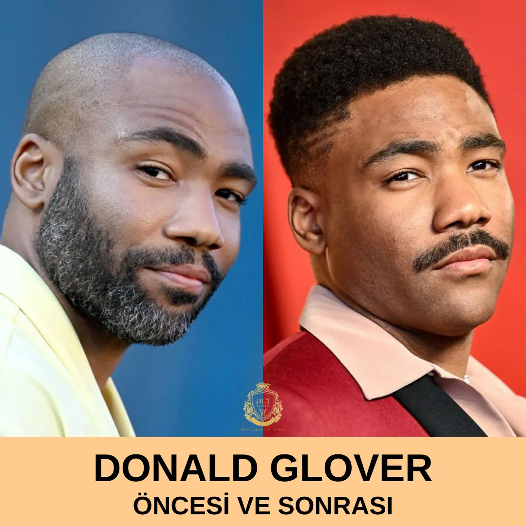 Donald Glover Hair Transplant|Donald Glover Saç Ekimi